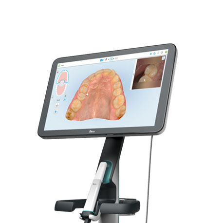itero digital impression system